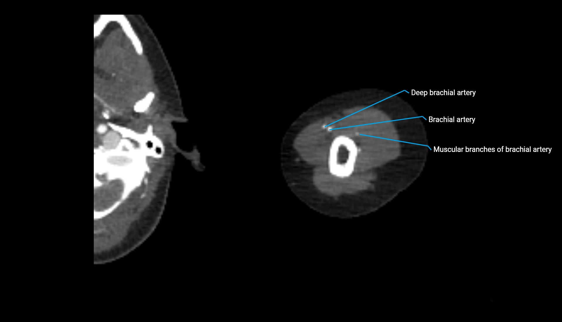 CTA upper limb axial cross sectional anatomy labelled image 269 (2).webp